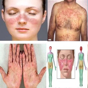 Penyebab-Penyakit-Lupus